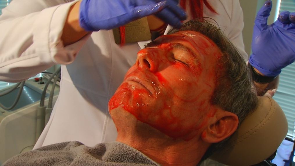 A new medical procedure dubbed the "vampire facial" is gaining popularity in Asheville, N.C. (WLOS)