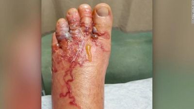 Image for story: Couple says they found worms in their feet after beach vacation